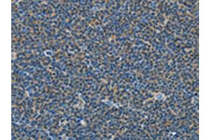 The image on the left is immunohistochemistry of paraffin-embedded Human lymphoma tissue using ABIN7129020(COX7B2 Antibody) at dilution 1/15, on the right is treated with fusion protein. (COX7B2 抗体)