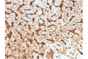 Formalin-fixed, paraffin-embedded human Hepatocellular Carcinoma stained with Albumin Mouse Monoclonal Antibody (ALB/2144). (Albumin 抗体)