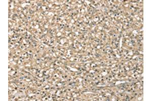 The image on the left is immunohistochemistry of paraffin-embedded Human prostate cancer tissue using ABIN7192556(SMAGP Antibody) at dilution 1/40, on the right is treated with synthetic peptide. (SMAGP 抗体)
