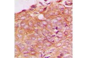Immunohistochemical analysis of SPTBN1 staining in human breast cancer formalin fixed paraffin embedded tissue section. (SPTBN1 抗体)