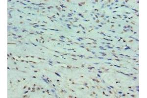 Immunohistochemistry of paraffin-embedded human breast cancer using ABIN7165931 at dilution of 1:100 (DARPP32 抗体  (Regulatory Subunit 1B))