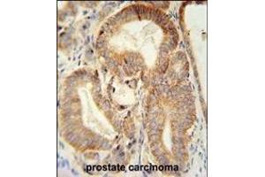 CLDN7 antibody (C-term) (ABIN654139 and ABIN2844008) immunohistochemistry analysis in formalin fixed and paraffin embedded human prostate carcinoma followed by peroxidase conjugation of the secondary antibody and DAB staining. (Claudin 7 抗体  (C-Term))