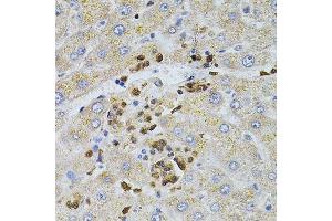 Immunohistochemistry of paraffin-embedded human liver injury using BEST1 antibody. (Bestrophin 1 抗体  (AA 200-300))