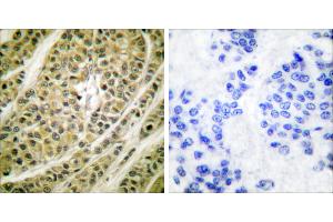 Peptide - +Immunohistochemical analysis of paraffin-embedded human breast carcinoma tissue using HDAC5 antibody (#C0225). (HDAC5 抗体)