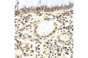 Immunohistochemistry of paraffin-embedded human gastric cancer using MCM4 Antibody (ABIN5971548) at dilution of 1/200 (40x lens). (MCM4 抗体)