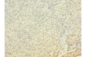 Immunohistochemistry of paraffin-embedded human cervical cancer using ABIN7152849 at dilution of 1:100 (FRS3 抗体  (AA 101-400))