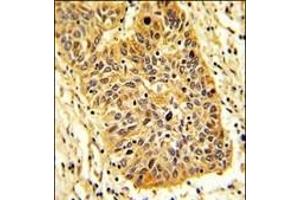Formalin-fixed and paraffin-embedded human lung carcinoma reacted with RIOK1 Antibody (N-term), which was peroxidase-conjugated to the secondary antibody, followed by DAB staining. (RIOK1 抗体  (N-Term))