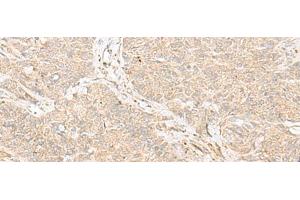 Immunohistochemistry of paraffin-embedded Human ovarian cancer tissue using TRAF6 Polyclonal Antibody at dilution of 1:30(x200) (TRAF6 抗体)