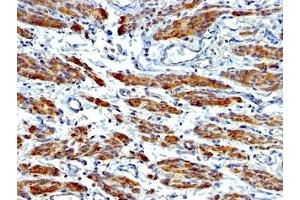 Formalin-fixed, paraffin-embedded human Leiomyosarcoma stained with SMMHC antibody (MYH11/923 + SMMS-1). (MYH11 抗体)