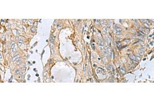 Immunohistochemistry of paraffin-embedded Human colorectal cancer tissue using MTHFD2 Polyclonal Antibody at dilution of 1:65(x200) (MTHFD2 抗体)