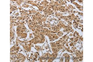 Immunohistochemistry of Human lung cancer using PSMD6 Polyclonal Antibody at dilution of 1:50 (PSMD6 抗体)