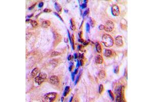 Immunohistochemistry (IHC) image for anti-Eukaryotic Translation Initiation Factor 4E Binding Protein 1 (EIF4EBP1) (pSer69) antibody (ABIN7301612)