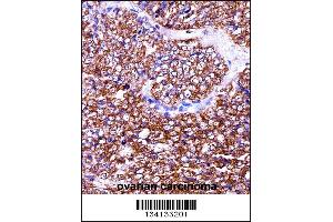 BAG2 Antibody immunohistochemistry analysis in formalin fixed and paraffin embedded human ovarian carcinoma followed by peroxidase conjugation of the secondary antibody and DAB staining. (BAG2 抗体  (C-Term))