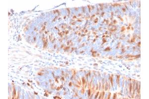 Formalin-fixed, paraffin-embedded human colon stained with Methyl-CpG Binding Domain Protein 1 Mouse Monoclonal Antibody (CPTC-MBD1-1) (MBD1 抗体)