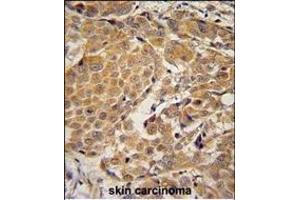 AWAT2 Antibody (C-term) (ABIN654780 and ABIN2844461) immunohistochemistry analysis in formalin fixed and paraffin embedded human skin carcinoma followed by peroxidase conjugation of the secondary antibody and DAB staining. (AWAT2 抗体  (C-Term))