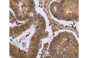 Immunohistochemistry of Human colon cancer using FHL2 Polyclonal Antibody at dilution of 1:50 (FHL2 抗体)