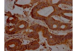 IHC image of ABIN7127483 diluted at 1:100 and staining in paraffin-embedded human colon cancer performed on a Leica BondTM system.