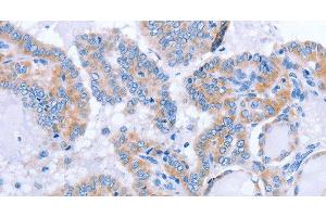 Immunohistochemistry of paraffin-embedded Human thyroid cancer tissue using FGF4 Polyclonal Antibody at dilution 1:40 (FGF4 抗体)