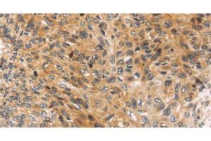 Immunohistochemistry of paraffin-embedded Human esophagus cancer using JNK2 Polyclonal Antibody at dilution of 1:30 (JNK2 抗体)