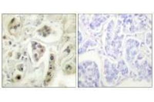 Immunohistochemical analysis of paraffin-embedded human lung carcinoma tissue using HSP60 antibody. (HSPD1 抗体)