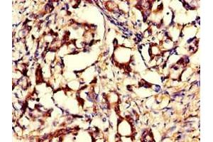 Immunohistochemistry of paraffin-embedded human gastric cancer using ABIN7153896 at dilution of 1:100