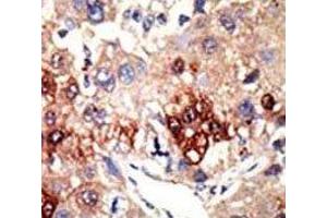 IHC analysis of FFPE human hepatocarcinoma tissue stained with the EZH2 antibody (EZH2 抗体)
