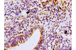 Immunohistochemistry of paraffin-embedded human lung cancer using ABIN7165698 at dilution of 1:100 (PKC beta 抗体  (AA 517-643))