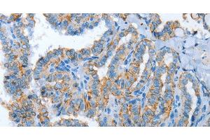 Immunohistochemistry of paraffin-embedded Human thyroid cancer tissue using ASL Polyclonal Antibody at dilution 1:35 (ASL 抗体)