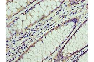 Immunohistochemistry of paraffin-embedded human colon cancer using ABIN7145038 at dilution of 1:100