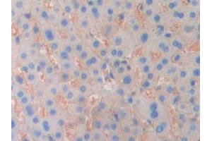 DAB staining on IHC-P; Samples: Human Liver cancer Tissue (ENPP1 抗体  (AA 625-780))