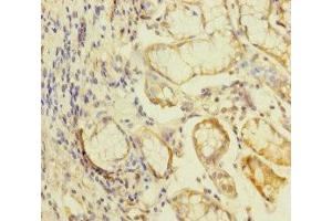 Immunohistochemistry of paraffin-embedded human gastric cancer using ABIN7157289 at dilution of 1:100 (KLHL26 抗体  (AA 366-615))