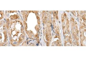 Immunohistochemistry of paraffin-embedded Human thyroid cancer tissue using PRNP Polyclonal Antibody at dilution of 1:45(x200) (PRNP 抗体)