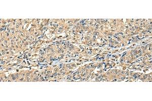 Immunohistochemistry of paraffin-embedded Human prost at e cancer tissue using CCDC112 Polyclonal Antibody at dilution of 1:45(x200) (CCDC112 抗体)