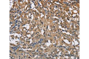Immunohistochemistry of Human thyroid cancer using ENO1 Polyclonal Antibody at dilution of 1:40 (ENO1 抗体)