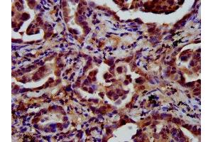 IHC image of ABIN7158226 diluted at 1:600 and staining in paraffin-embedded human lung cancer performed on a Leica BondTM system. (LIFR 抗体  (AA 915-1086))