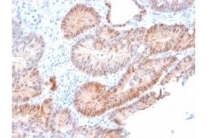 Formalin-fixed, paraffin-embedded human Prostate Carcinoma stained with AKR1C2 Mouse Monoclonal Antibody (CPTC-AKR1C2-1). (AKR1C2 抗体)