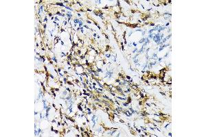 Immunohistochemistry of paraffin-embedded human lung cancer using PSMB9/LMP2 Rabbit mAb (ABIN7269596) at dilution of 1:100 (40x lens). (PSMB9 抗体)