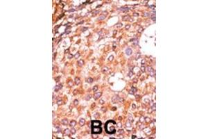 Formalin-fixed and paraffin-embedded human cancer tissue reacted with the primary antibody, which was peroxidase-conjugated to the secondary antibody, followed by AEC staining. (E2F1 抗体  (pSer337))