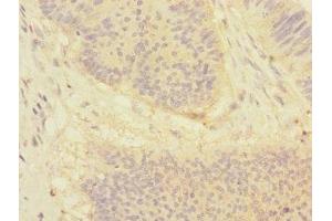 Immunohistochemistry of paraffin-embedded human colon cancer using ABIN7149768 at dilution of 1:100 (Desmocollin 1 抗体  (AA 480-690))