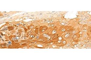 Immunohistochemistry of paraffin-embedded Human esophagus cancer tissue using DNAJC8 Polyclonal Antibody at dilution of 1:35(x200) (DNAJC8 抗体)