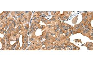 Immunohistochemistry of paraffin-embedded Human thyroid cancer tissue using INF2 Polyclonal Antibody at dilution of 1:40(x200) (INF2 抗体)