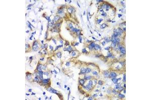 Immunohistochemistry of paraffin-embedded human liver cancer using RPL9 antibody. (RPL9 抗体  (AA 1-192))