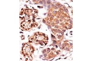 Formalin-fixed and paraffin-embedded human cancer tissue reacted with the primary antibody, which was peroxidase-conjugated to the secondary antibody, followed by AEC staining. (ABL2 抗体  (pTyr393, pTyr439))