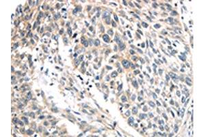 The image on the left is immunohistochemistry of paraffin-embedded Human lung cancer tissue using ABIN7191116(IQGAP2 Antibody) at dilution 1/40, on the right is treated with synthetic peptide. (IQGAP2 抗体)