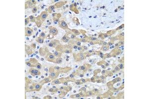 Immunohistochemistry of paraffin-embedded human liver cancer using GFM1 antibody at dilution of 1:100 (40x lens). (GFM1 抗体)