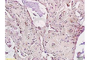 Formalin-fixed and paraffin embedded human rectal carcinoma labeled Anti-LDL receptor Polyclonal Antibody, Unconjugated (ABIN672111) at 1:200, followed by conjugation to the secondary antibody and DAB staining (LDLR 抗体  (AA 781-860))
