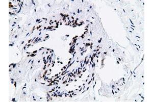 Immunohistochemical staining of paraffin-embedded Carcinoma of Human kidney tissue using anti-NT5DC1 mouse monoclonal antibody. (NT5DC1 抗体)
