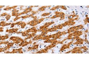 Immunohistochemistry of paraffin-embedded Human liver cancer tissue using Claudin 10 Polyclonal Antibody at dilution 1:50 (CLDN10 抗体)