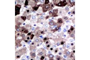 Immunohistochemical analysis of DGK iota staining in human liver cancer formalin fixed paraffin embedded tissue section. (DGKI 抗体  (C-Term))