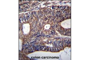 UQCRB Antibody (Center) (ABIN656932 and ABIN2846122) immunohistochemistry analysis in formalin fixed and paraffin embedded human colon carcinoma followed by peroxidase conjugation of the secondary antibody and DAB staining. (UQCRB 抗体  (AA 19-47))